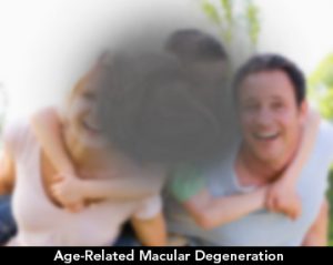AgeRelatedMacularDegneration